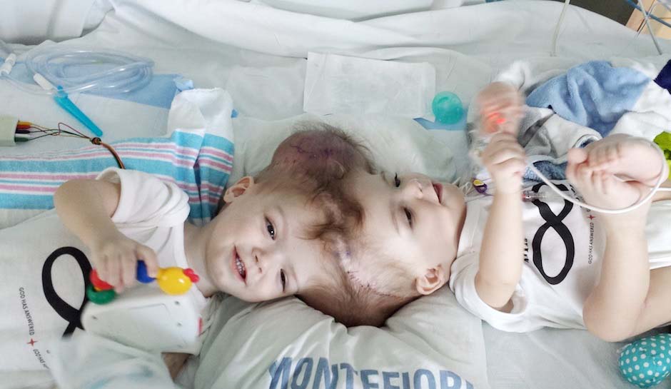 conjoined-twins