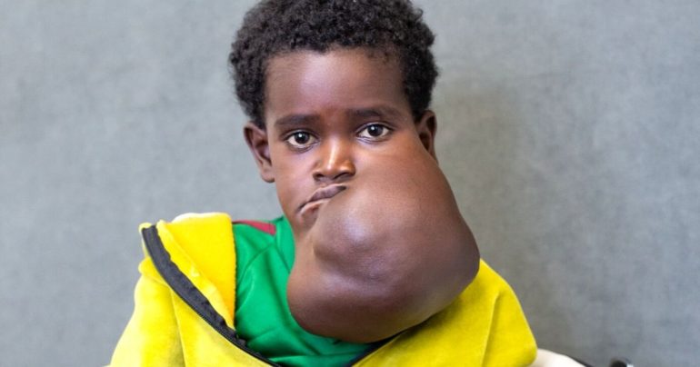 nagalem haile facial tumor