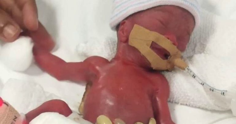 world's smallest baby born Yu Xuan