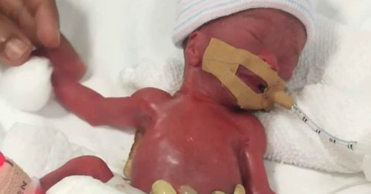world's smallest baby born Yu Xuan