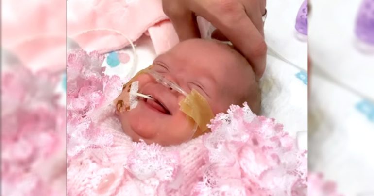 premature-labor-twins-22-weeks