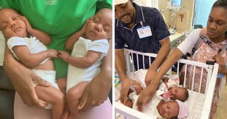 rare momo twins born holding each other